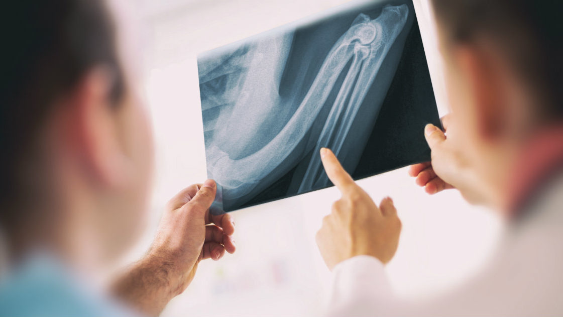 osteoporosi