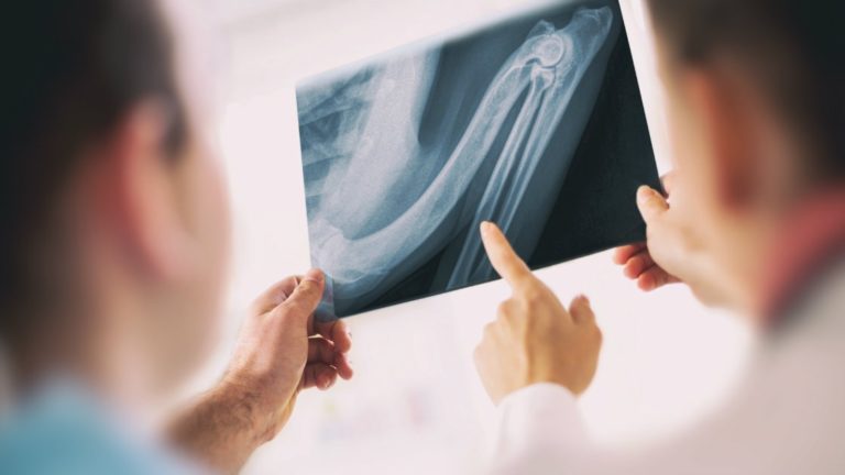 osteoporosi
