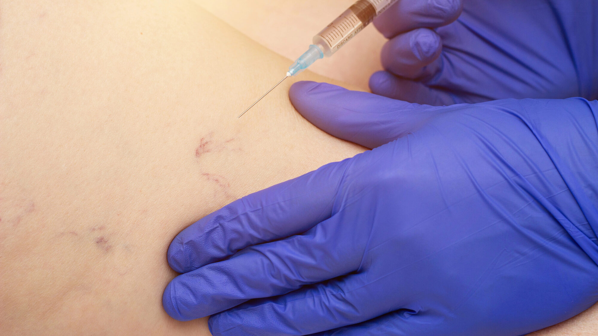 sclerosante